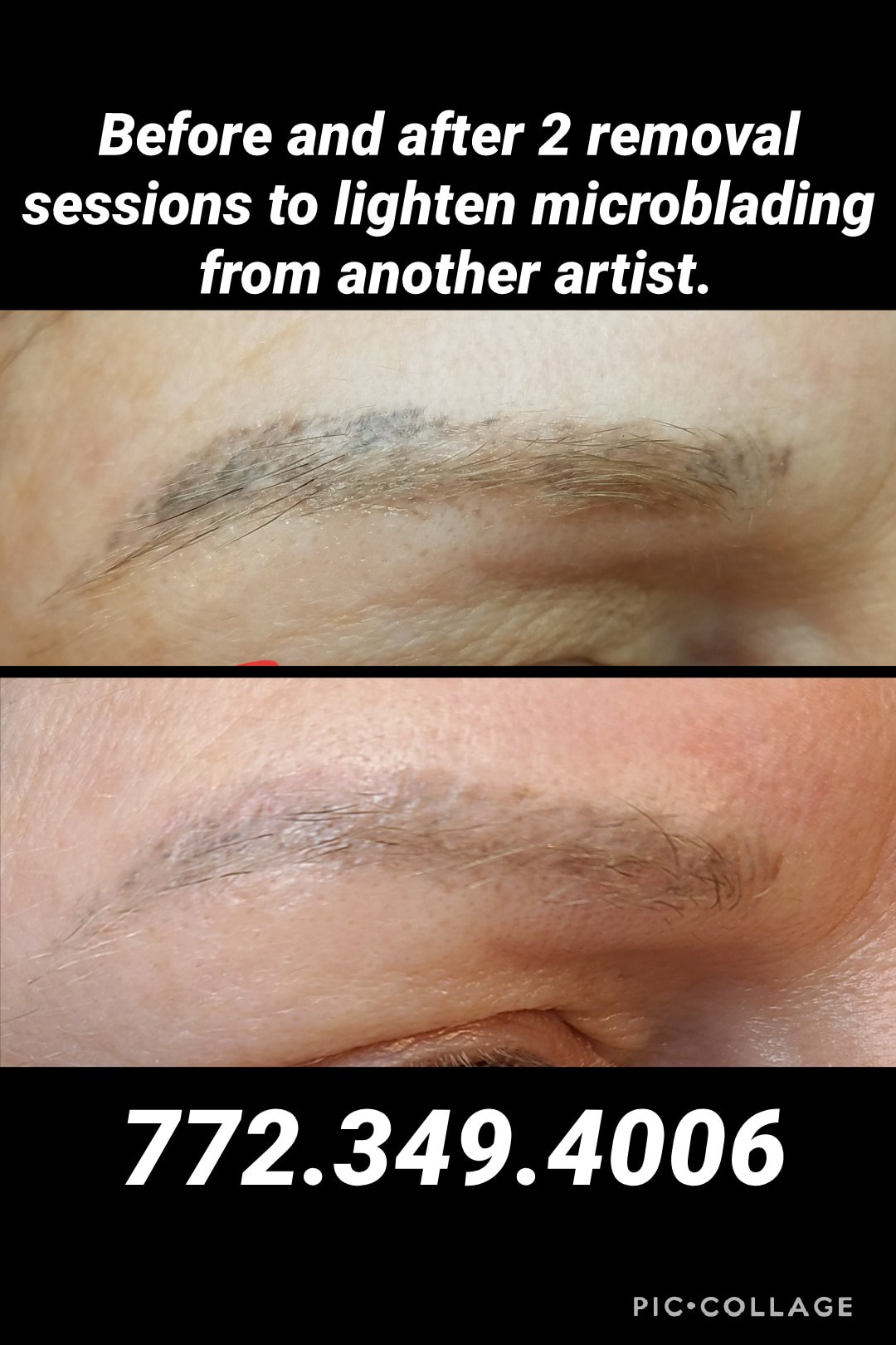 Tattoo Removal Gallery - Permanent Makeup By Julie
